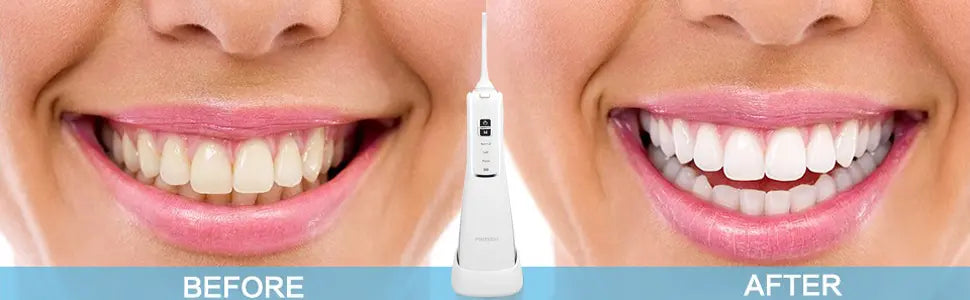 Water Flosser - ES-1174 Detail Image