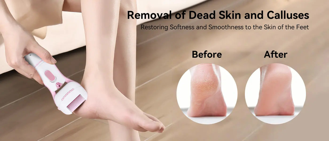 PRITECH Callus Remover | BCM-1058
