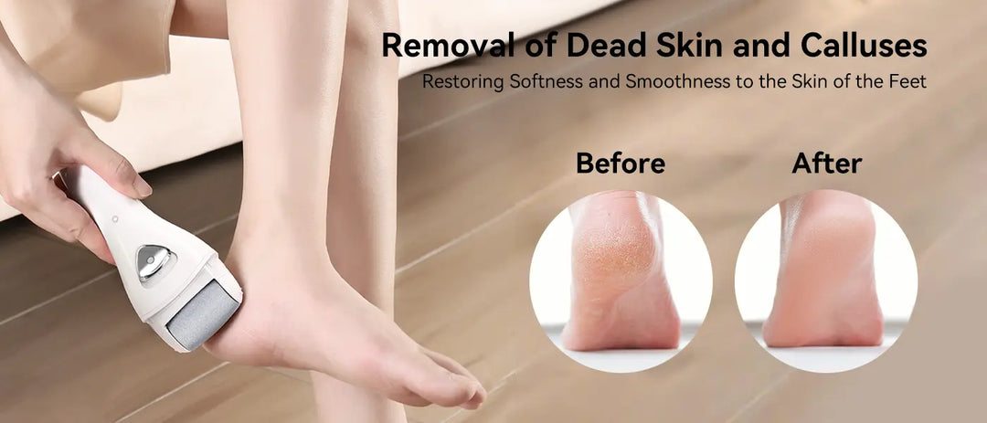 PRITECH Callus Remover | BCM-1138