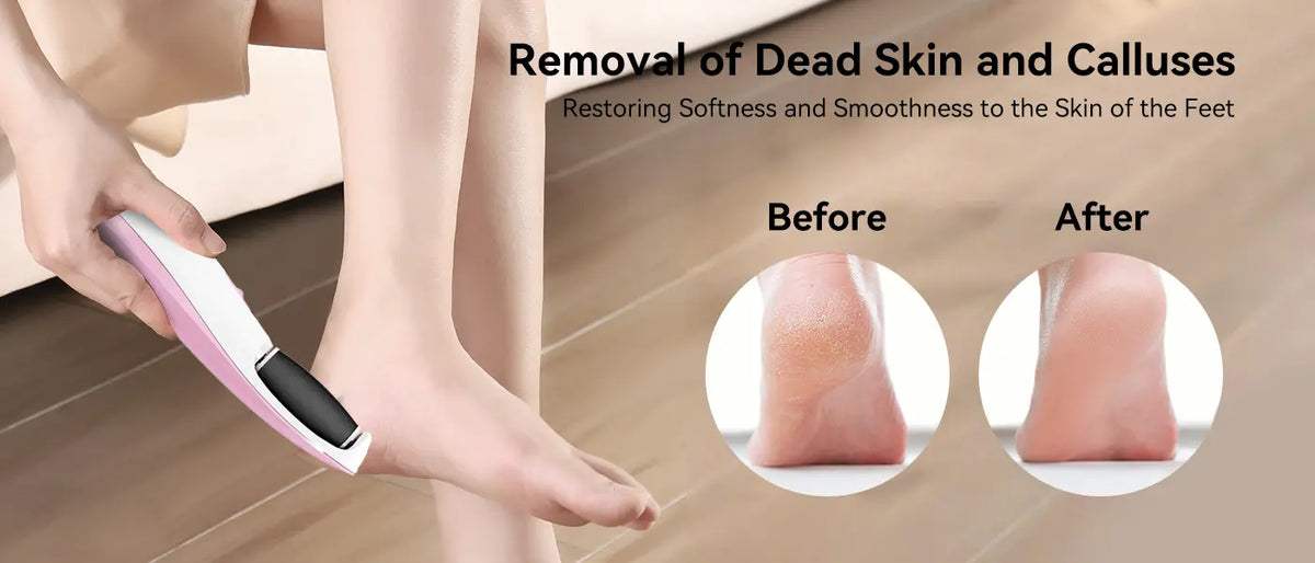 Callus Remover - BCM-1135 Detail Image